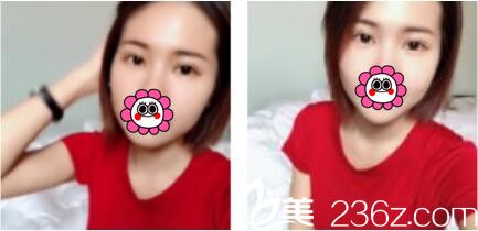 九零后小姐姐亲身经历告诉你上海万丽李辉做双眼皮怎么样？三个月过去了眼睛看上去特别自然