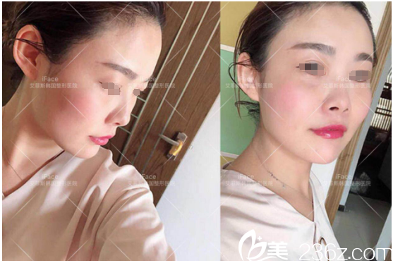 术前鼻孔外露的朝天鼻 术前鼻孔外露的朝天鼻