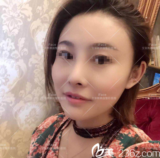 术后一周拆线鼻综合恢复 术后一周拆线鼻综合恢复