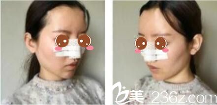 上海万丽医疗美容门诊部张至德假体隆鼻真人案例术后第三天