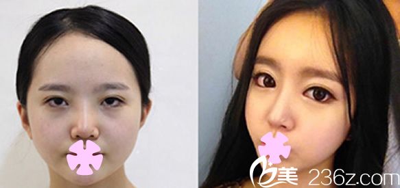 本沐整形医院,双眼皮和面部填充术后效果 本沐整形医院,双眼皮和面部填充术后效果