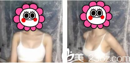 就我这平胸多亏上海万丽李辉为我做了假体隆胸，三个月的时间就让我拥有迷人的S曲线