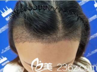 发际线种植一周