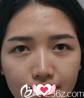 术前内双眼皮 术前内双眼皮