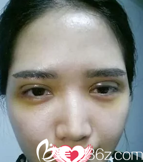 刚做完手术眼睛肿胀 刚做完手术眼睛肿胀