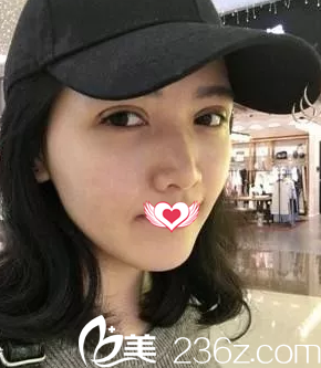 术后7天眼睛拆线后的样子 术后7天眼睛拆线后的样子