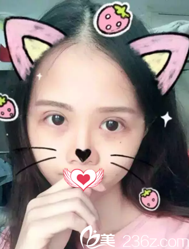 术后7天双眼皮拆线后的样子 术后7天双眼皮拆线后的样子