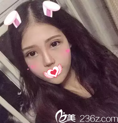 双眼皮25天完全消肿 双眼皮25天完全消肿