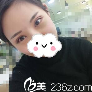 切开双眼皮术后天 切开双眼皮术后天