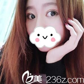 割双眼皮术后半个月 割双眼皮术后半个月