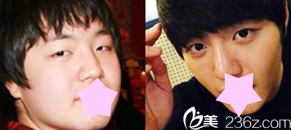 本沐整形医院眼睛和鼻子术前后效果 本沐整形医院眼睛和鼻子术前后效果