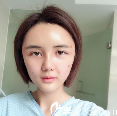 找深圳美莱整形医院梁晓健做完自体脂肪弹窗第二天效果图