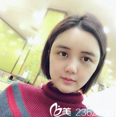 深圳美莱梁晓健做的自体脂肪填充术后十天图片