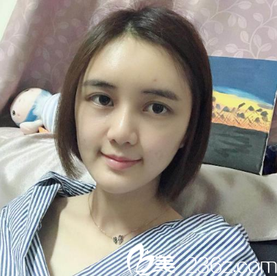 深圳美莱梁晓健自体脂肪全脸填充术后二十天恢复图片