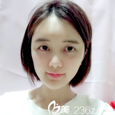 深圳美莱梁晓健做的自体脂肪面部填充案例术后一个月图片