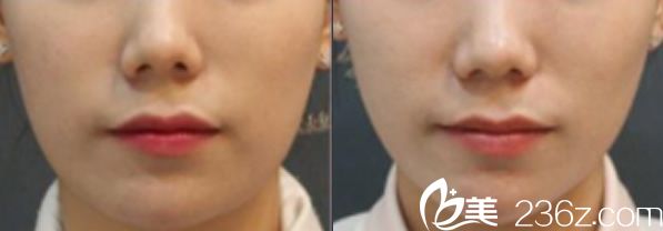 本沐整形埋线提升前后效果图 本沐整形埋线提升前后效果图