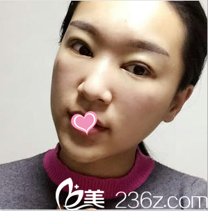 北京樱桃双眼皮修复