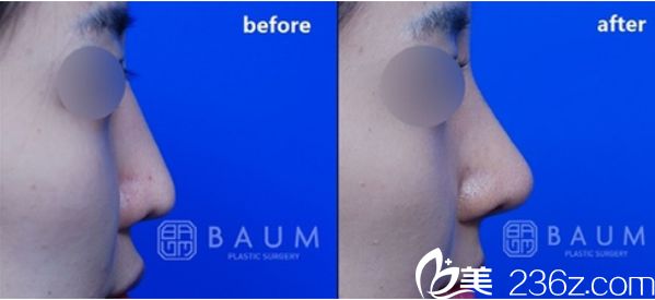 韩国柏恩整形鼻整形效果对比图 韩国柏恩整形鼻整形效果对比图