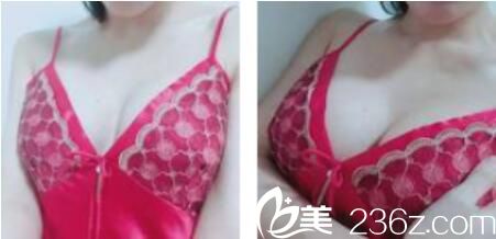 在上海洁找铭陶玉凤做假体隆胸三个月，术后呈现水滴形而且手感还很柔软