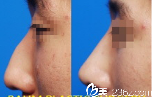韩国伯恩整形外科鼻部整形对比图