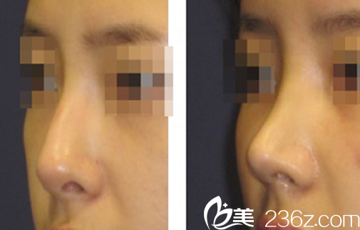 韩国伯恩整形美容医院鼻综合效果图 韩国伯恩整形美容医院鼻综合效果图