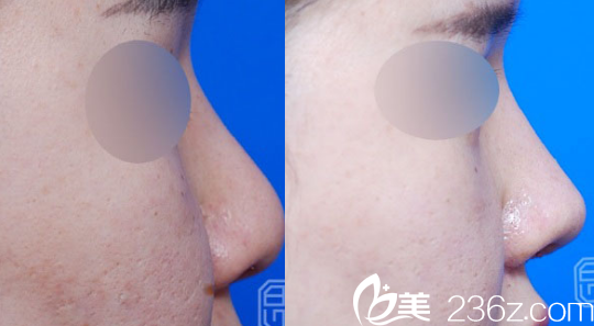 韩国伯恩整形外科鼻综合效果图 韩国伯恩整形外科鼻综合效果图