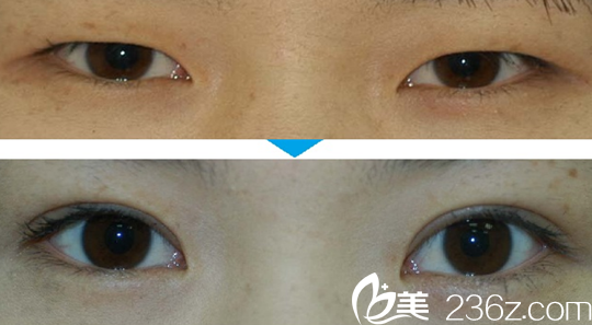 韩国柏恩整形外科眼综合效果图 韩国柏恩整形外科眼综合效果图