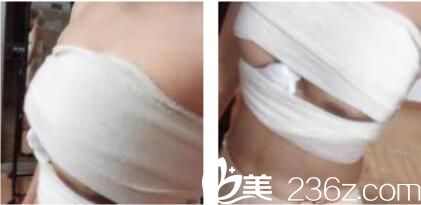上海玛丽医院整形美容中心王海龙假体隆胸真人案例术后第三天