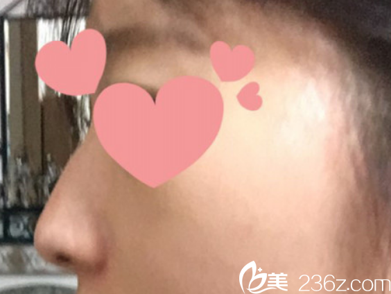 韩国柏恩整形外科鼻综合整形案例图 韩国柏恩整形外科鼻综合整形案例图