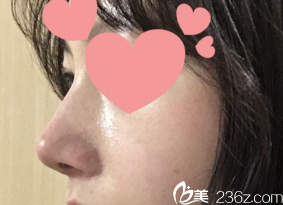 韩国柏恩整形医院鹰钩鼻整形术后图 韩国柏恩整形医院鹰钩鼻整形术后图