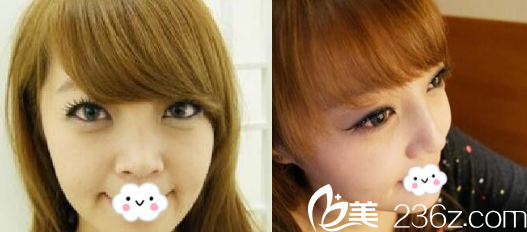 公开！烟台鹏爱整形医院pk烟台美神美容医院，手术价格+鼻综合自体脂肪填充切开双眼皮实例