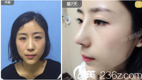 烟台鹏爱整形医院魏璐术前照片1