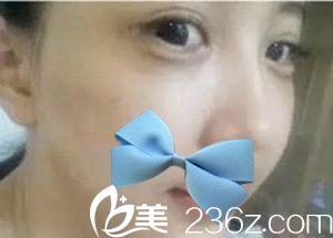 濮阳源美温赏做的面部脂肪填充 濮阳源美温赏做的面部脂肪填充