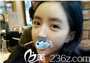 濮阳源美温赏做的面部脂肪填充术后2周 濮阳源美温赏做的面部脂肪填充术后2周