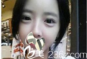 濮阳源美温赏做的面部脂肪填充术后1个月 濮阳源美温赏做的面部脂肪填充术后1个月