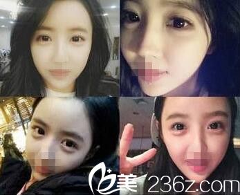 在濮阳源美温赏做了面部脂肪填充 别人根本看不出我的整形痕迹