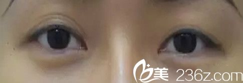 韩国本沐整形都镇雨院长为我做双眼皮修复前 韩国本沐整形都镇雨院长为我做双眼皮修复前