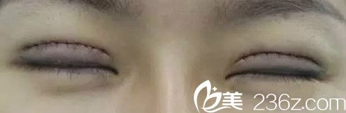 双眼皮修复天 双眼皮修复天