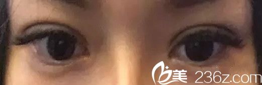 割双眼皮20天后的效果 割双眼皮20天后的效果