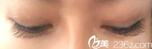 三个月后双眼皮的二次修复图 三个月后双眼皮的二次修复图