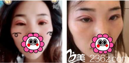 上海澳雅医疗美容门诊部 张勍枫双眼皮真人案例术后第三天
