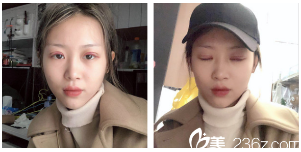 找广州军美产慎之做完双眼皮第二天效果图 找广州军美产慎之做完双眼皮第二天效果图