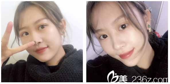 广州军美产慎之双眼皮案例术后十天自拍 广州军美产慎之双眼皮案例术后十天自拍