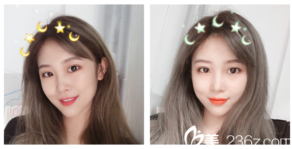 广州军美整形医院产慎之医生双眼皮案例术后三个月图片 广州军美整形医院产慎之医生双眼皮案例术后三个月图片