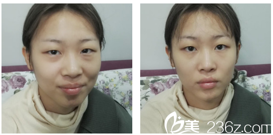 来广州军美做双眼皮前的照片 来广州军美做双眼皮前的照片