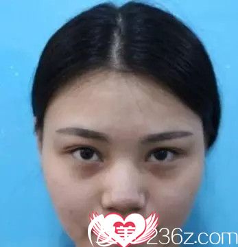 术前眼睛不好看没神韵 术前眼睛不好看没神韵