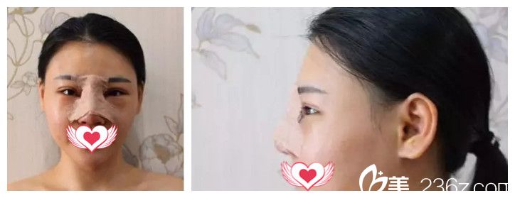 双眼皮后做鼻综合术后即刻 双眼皮后做鼻综合术后即刻