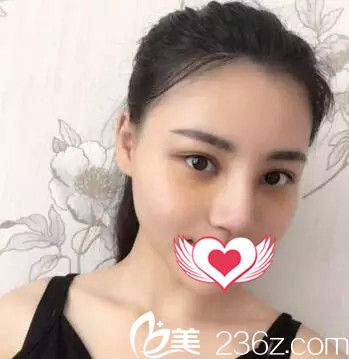 术后一周拆线鼻子消肿恢复 术后一周拆线鼻子消肿恢复