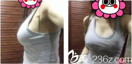 上海澳雅医疗美容门诊部张勍枫自体脂肪隆胸真人案例术后第七天
