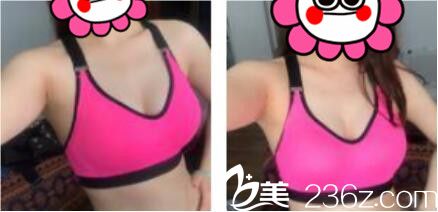 上海澳雅医疗美容门诊部张勍枫自体脂肪隆胸真人案例术后一个月